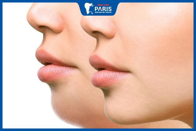 Độn cằm phù hợp với người cằm ngắn