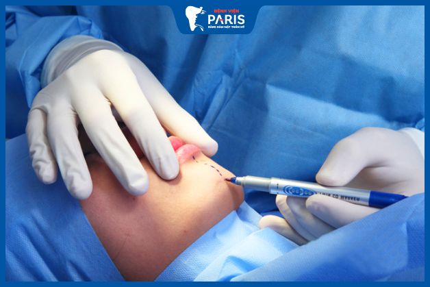 Bác sĩ đo vẽ trước khi bắt đầu phẫu thuật độn cằm