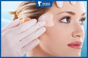 Độn thái dương mấy ngày cắt chỉ – 3 yếu tố tác động trực tiếp