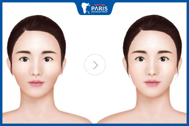 Hạ gò má có nguy hiểm không