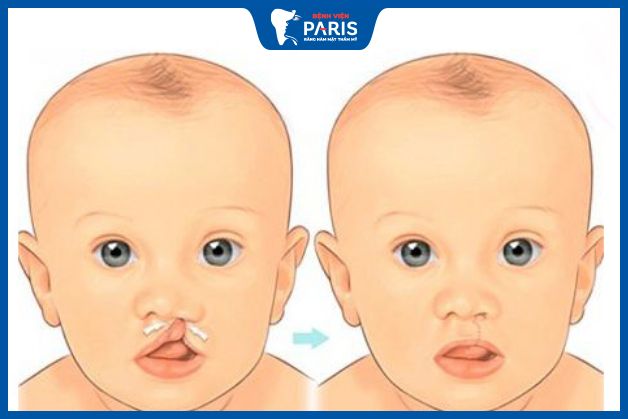 Hở hàm ếch bao lâu thì phẫu thuật được