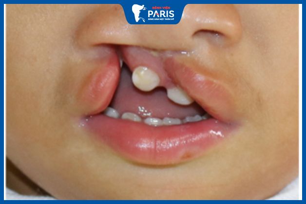Răng bị kẹt khi hở hàm ếch