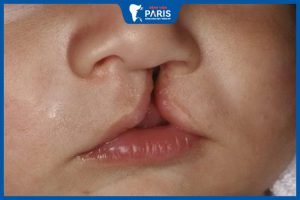 Giải đáp thắc mắc: Hở hàm ếch có ảnh hưởng gì không