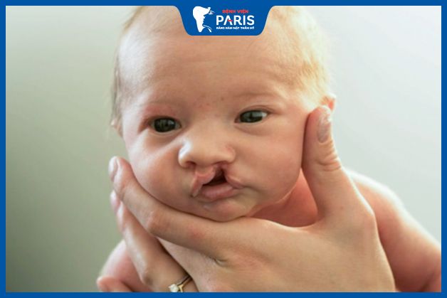 Trẻ không nên chữa hở hàm ếch quá sớm