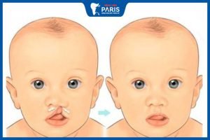 Hở hàm ếch có chữa được không – Lưu ý quan trọng