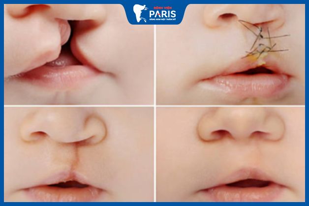 Cấu trúc môi được khôi phục sau khi phẫu thuật