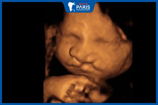 Siêu âm có thể phát hiện dị tật hở hàm ếch