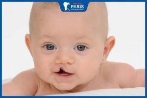 Hở hàm ếch có di truyền không – Phương pháp chữa trị