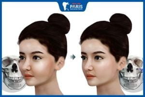 Hướng dẫn cách chăm sóc sau phẫu thuật hạ gò má cực chuẩn
