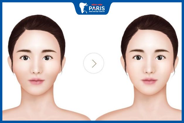 Kết quả của phẫu thuật hạ gò má kéo dài bao lâu?