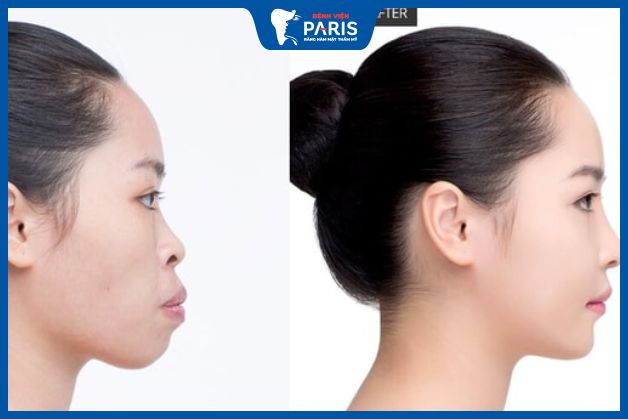 Không để lại sẹo trên mặt