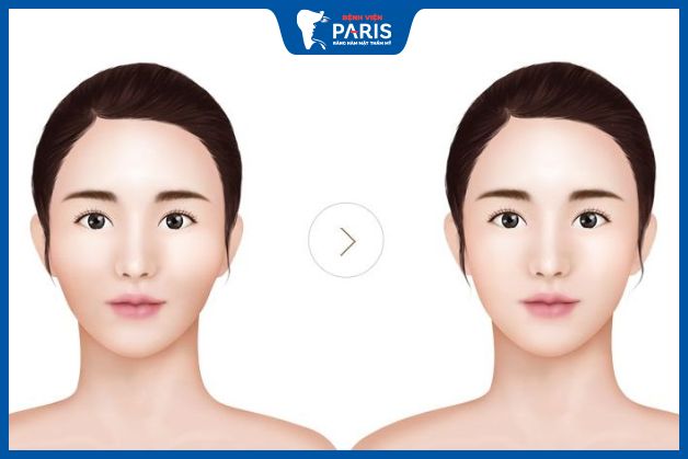 Phẫu thuật hạ gò má hoàn toàn có thể duy trì kết quả vĩnh viễn
