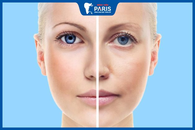Biến chứng khi hạ gò má - Má bị chảy xệ