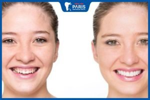Mách bạn các cách cười không hở lợi siêu đơn giản, hiệu quả