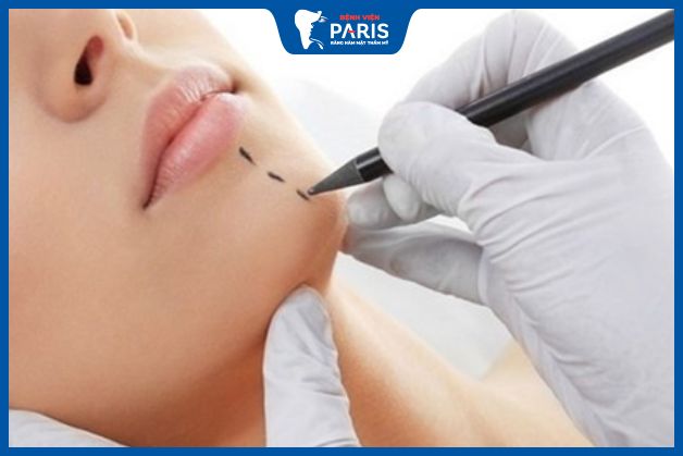 Bác sĩ vẽ dáng cằm mới