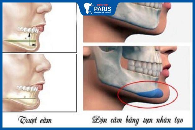 Mức độ xâm lấn