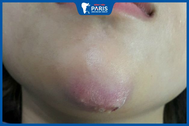 Nguyên nhân gây ra tình trạng bao xơ sau độn cằm