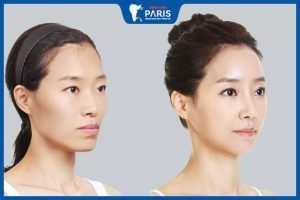 9 Biến chứng đáng lo ngại khi phẫu thuật hạ gò má
