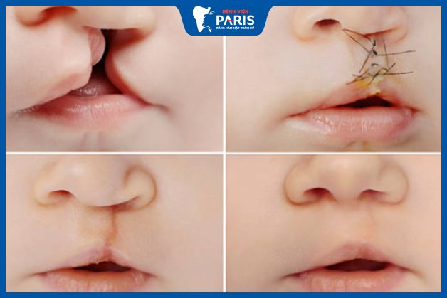 Những điều cần lưu ý khi phẫu thuật hở hàm ếch
