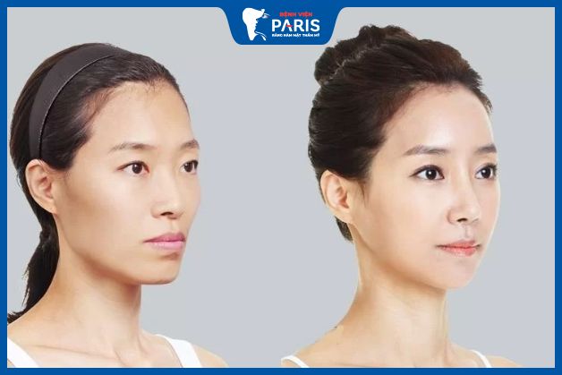 Những lưu ý khi chăm sóc sau khi phẫu thuật hạ gò má