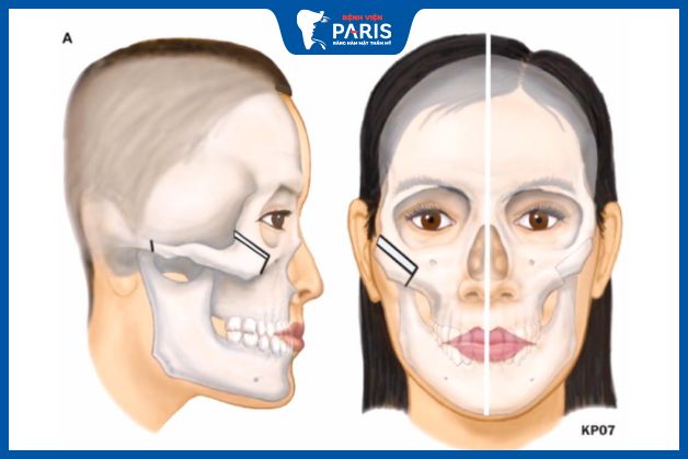 Phẫu thuật hạ gò má có đau không?