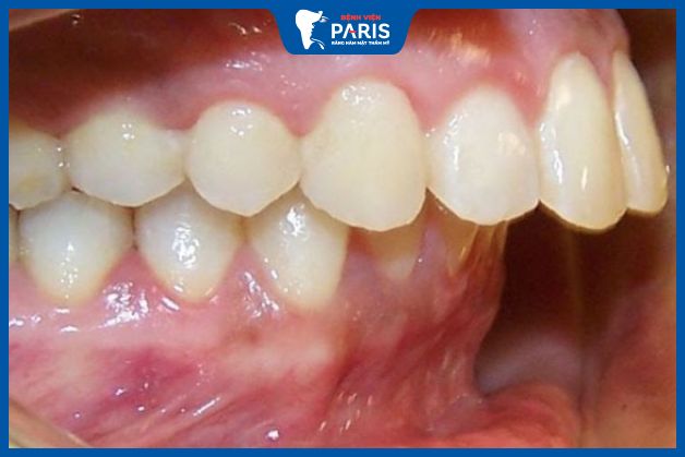 Phương pháp Lefort 1 phù hợp với người có xương hàm trên quá phát