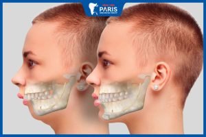 Phẫu thuật hàm hô không cần nhổ răng là gì, lưu ý quan trọng