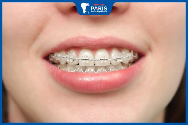 Phẫu thuật hàm hô cần niềng răng đối với trường hợp hô do cả xương hàm và răng