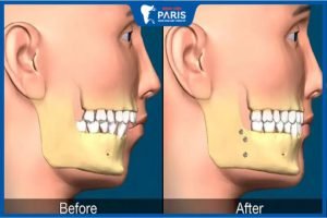 Phẫu thuật hàm hô không cần niềng răng: Những điều bạn nên biết
