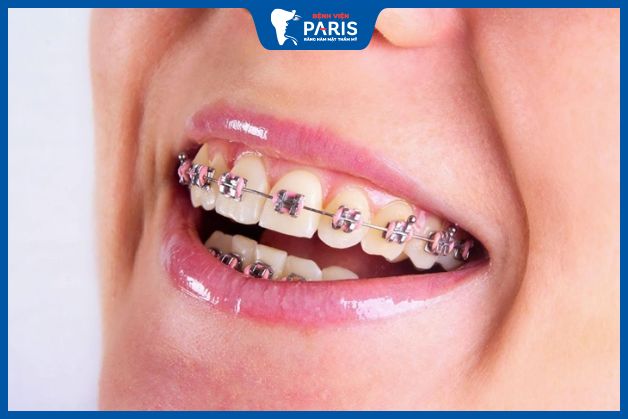 Phẫu thuật hàm hô không cần niềng răng - Trường hợp không thực hiện được