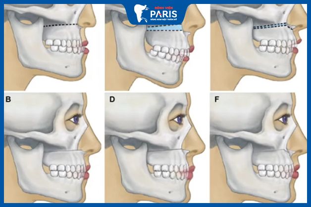 Phẫu thuật hàm hô không cần niềng răng - Trường hợp thực hiện được