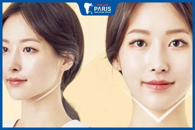 Vì sao cần kiêng quan hệ vợ chồng sau khi độn cằm
