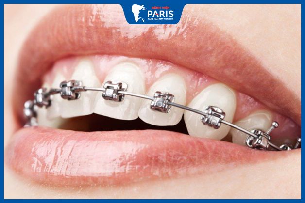 Chỉnh hàm lệch không phẫu thuật bằng niềng răng kim loại