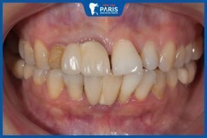 Chỉnh hàm lệch không phẫu thuật: Các phương pháp hiệu quả và an toàn nhất