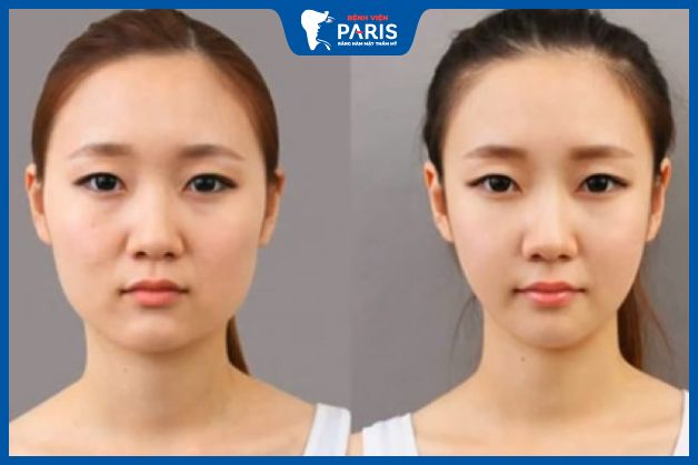 Độn cằm sau 1 tháng còn đau không