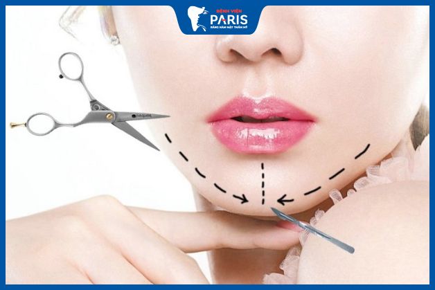 Độn cằm sau 10 ngày cắt chỉ được chưa