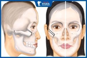 Hạ gò má 1 bên: Những rủi ro và cách giảm thiểu