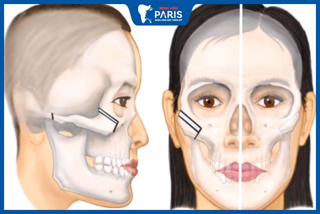 Hạ gò má 1 bên với phương pháp phẫu thuật
