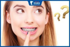 Niềng răng có hạ gò má không? Sự thật và những điều cần biết