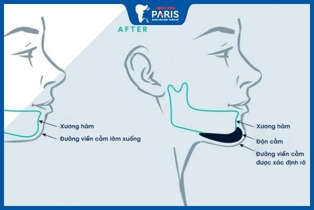 Quá trình phục hồi sau khi độn cằm
