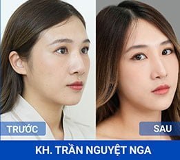 Nâng mũi cấu trúc – Chuẩn y khoa