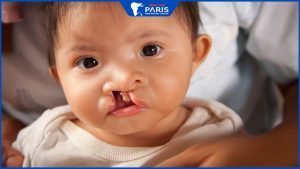 Hở hàm ếch ở trẻ xảy ra do đâu, Tìm hiểu cách điều trị