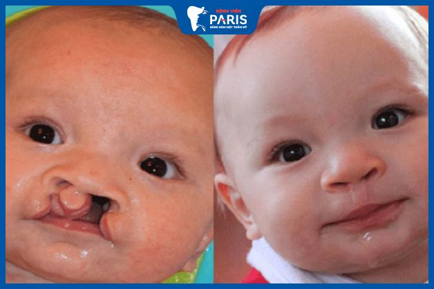 Phẫu thuật có thể chữa hở vòm miệng
