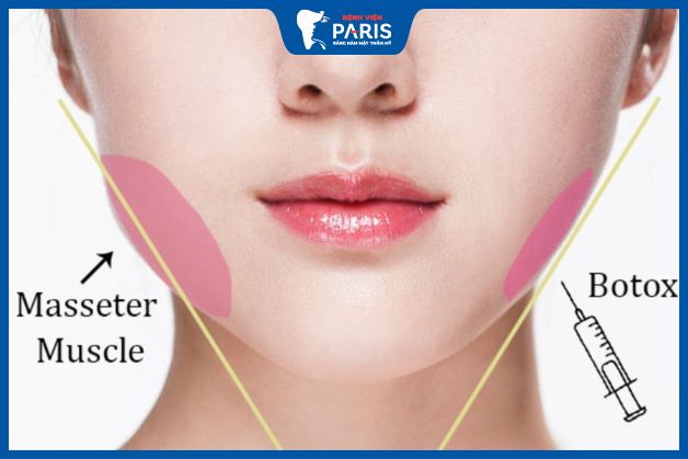 Phương pháp tiêm botox gọn hàm
