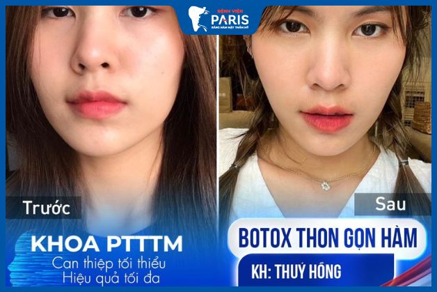 Khách hàng sau khi tiêm botox