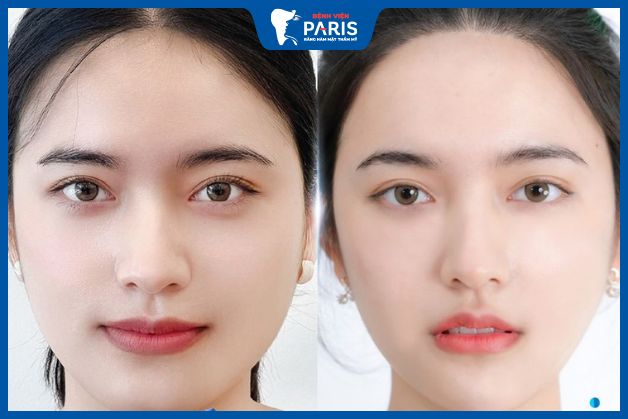 Hình ảnh trước và sau khi tiêm botox