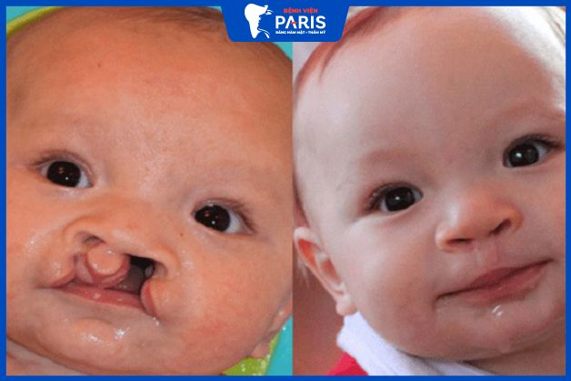 Điều trị sứt môi và hở hàm ếch