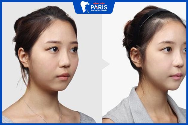 Độn thái dương sau bao lâu thì đẹp