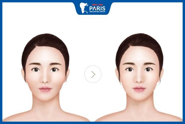 Phẫu thuật hạ gò má không nguy hiểm