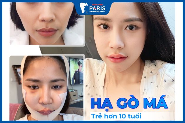 Hạ gò má lành hẳn sau 1 - 3 tháng